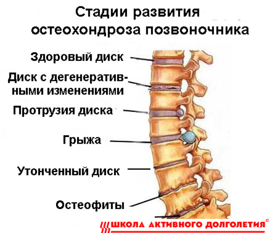 Статические нарушения позвоночника. Задние остеофиты позвонков с4-с5. Хондроз поясничного отдела 2 позвонок. Остеохондроз, протрузия, грыжа межпозвоночного диска. Стадии развития остеохондроза.